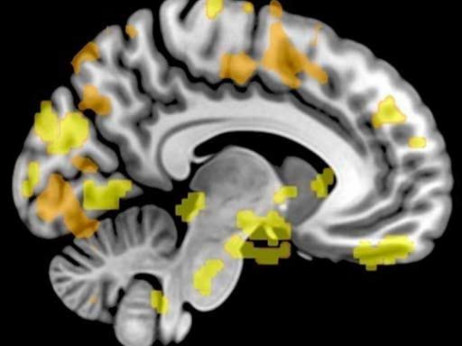 Prvo komercijalno sučelje mozak-računalo ulazi u fazu ljudskog ispitivanja